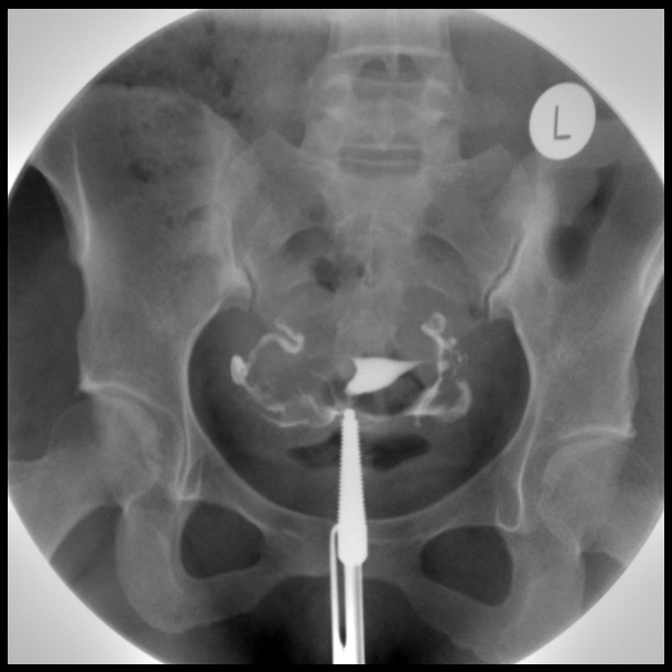 Hysterosalpingography